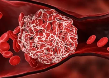 8 მთავარი ნაშანი იმისა, რომ სისხლძარღვებში საშიში თრომბი გაქვთ