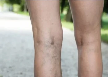 მთავარი ნიშნები, რითაც მიხვდებით, რომ სისხლძარღვებში საშიში თრომბი გაქვთ