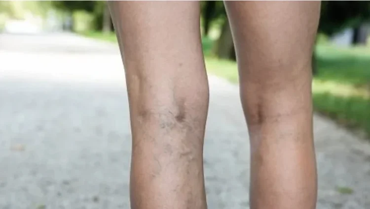 მთავარი ნიშნები, რითაც მიხვდებით, რომ სისხლძარღვებში საშიში თრომბი გაქვთ