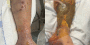 “ხორცმჭამელმა ბაქტერიამ უკვე მეხუთე ადამიანი იმსხვერპლა” – გიორგი ფხაკაძე