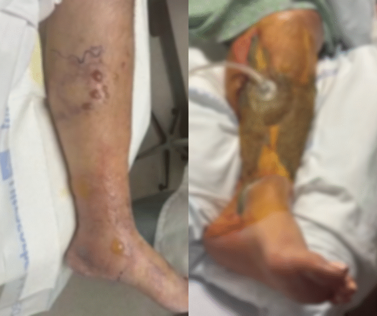 “ხორცმჭამელმა ბაქტერიამ უკვე მეხუთე ადამიანი იმსხვერპლა” – გიორგი ფხაკაძე