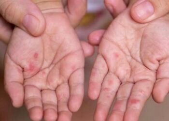 გურჯაანის მუნიციპალიტეტში ბავშვებში კოკსაკის ვირუსის შემთხვევები გამოვლინდა